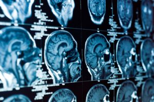 Brain Injuries And Long-Term Care